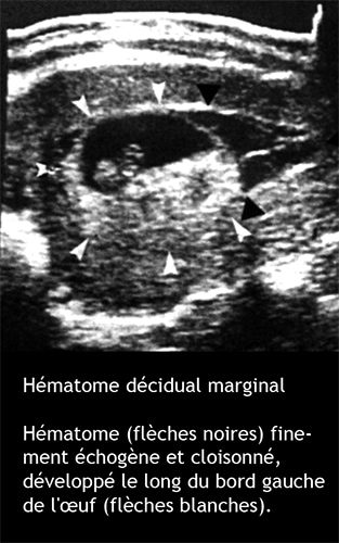 hématome décidual