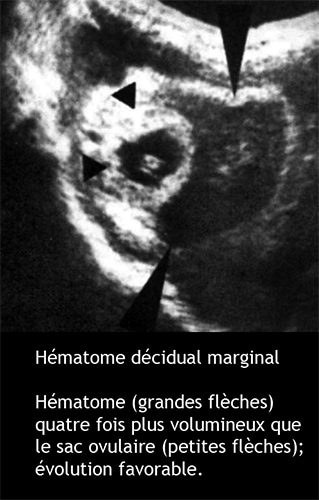 hématome décidual