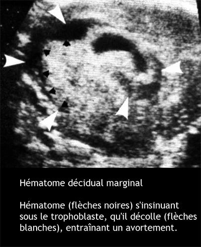 hématome décidual
