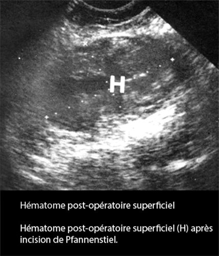Hématome post-op