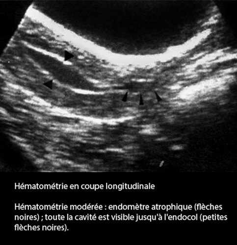 Hématométrie — rétention sang intra-utérine image échographique 1