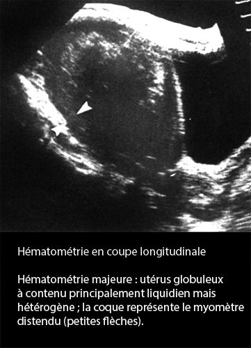 Hématométrie — rétention sang intra-utérine image échographique 2