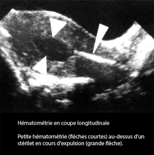 Hématométrie — rétention sang intra-utérine image échographique 3