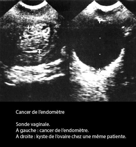 Hématométrie — rétention sang intra-utérine image échographique 4