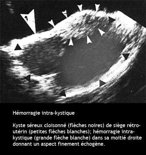 Hémorragie intra-kystique