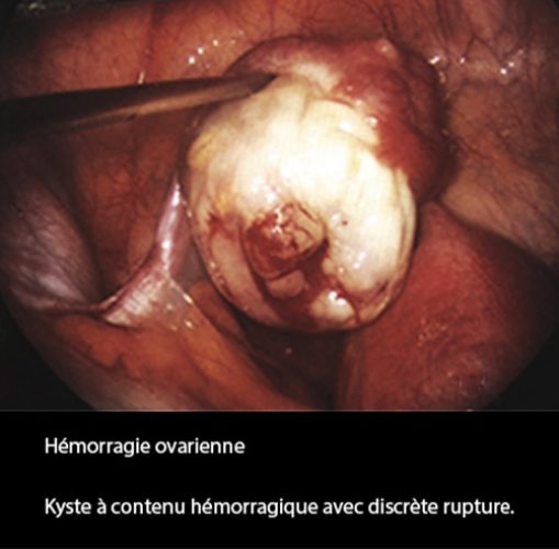 Hémorragie ovarienne — hémopéritoine image échographique urgence