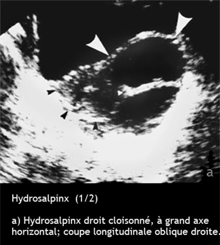 Hydrosalpinx — dilatation tubaire chronique image coelioscopique 1