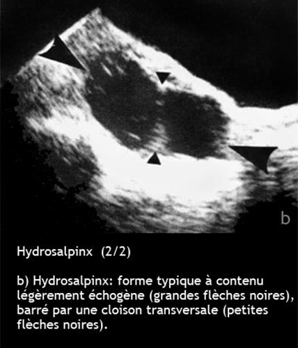 Hydrosalpinx — dilatation tubaire chronique image coelioscopique 2