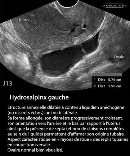 Hydrosalpinx — dilatation tubaire chronique image coelioscopique 3