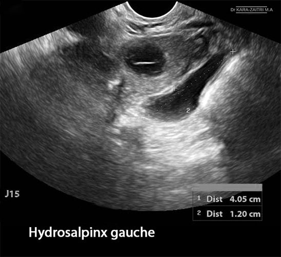 Hydrosalpinx — dilatation tubaire chronique image coelioscopique 4