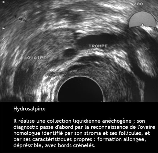 Hydrosalpinx — dilatation tubaire chronique image coelioscopique 5