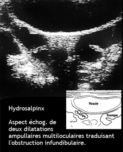 Hydrosalpinx — dilatation tubaire chronique image coelioscopique 6