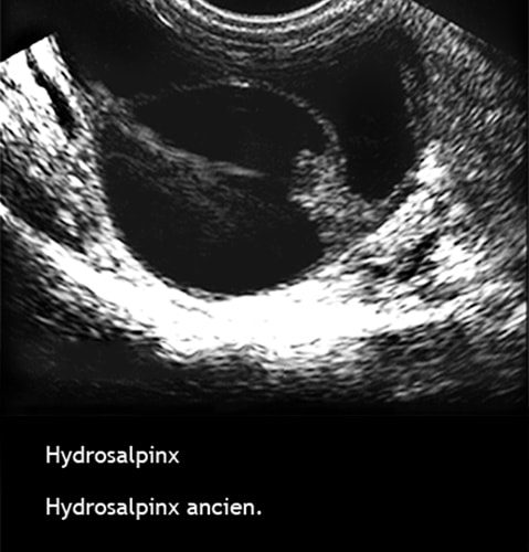 Hydrosalpinx — dilatation tubaire chronique image coelioscopique 7