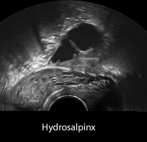 Hydrosalpinx — dilatation tubaire image échographique gynécologique
