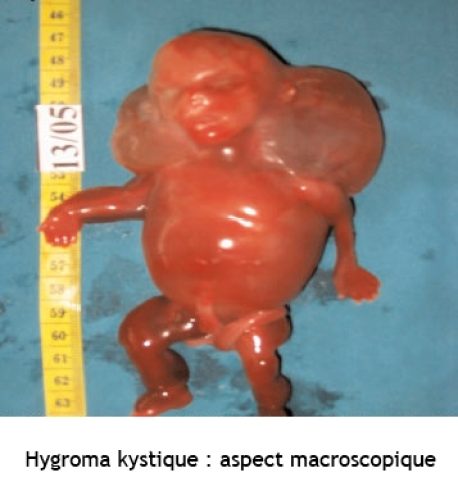 hygroma kystique
