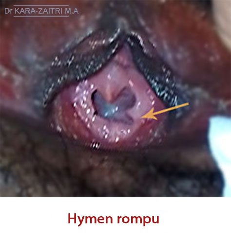 Hymen - Dr KARA-ZAITRI M.A - Gynécologue-Obstétricien