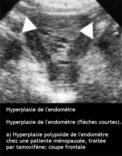 Hyperplasie endométriale — épaississement pathologique endomètre 1