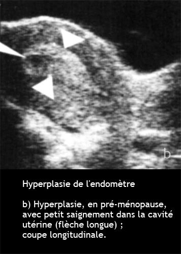 Hyperplasie endométriale — épaississement pathologique endomètre 2