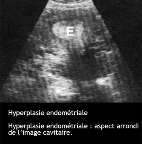 Hyperplasie endométriale — épaississement pathologique endomètre 3