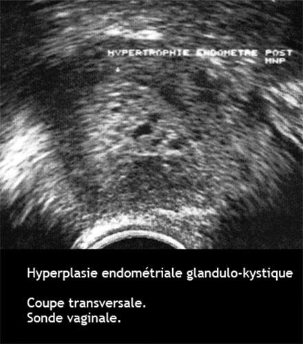 Hyperplasie endométriale — épaississement pathologique endomètre 4