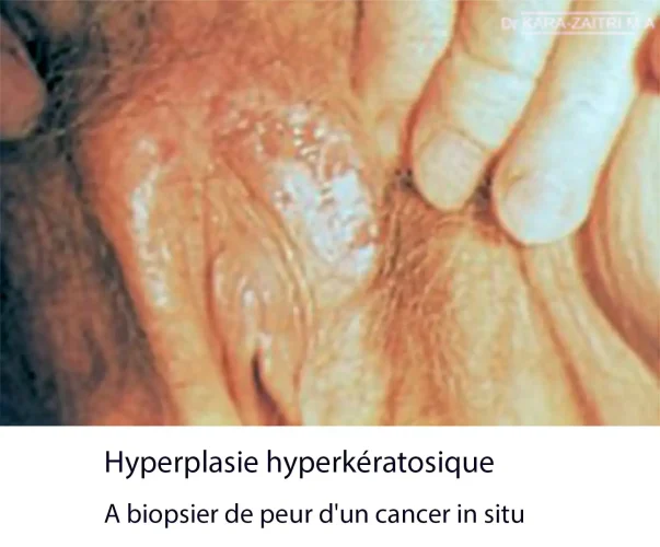 lésions blanches de la vulve. Hyperplasie hyperkératosique vulvaire — dystrophie vulvaire