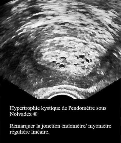 Hypertrophie endométriale sous tamoxifène — effet secondaire hormonal