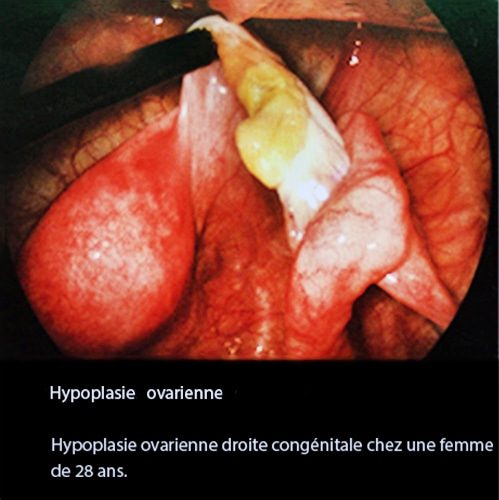 Hypoplasie ovarienne