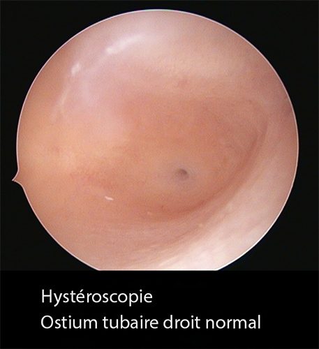 Hystéroscopie 6