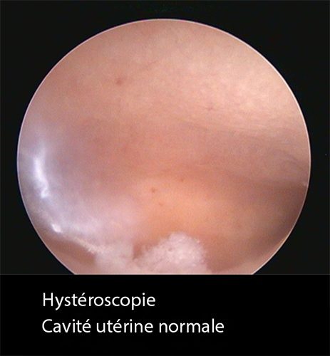 Hystéroscopie 8