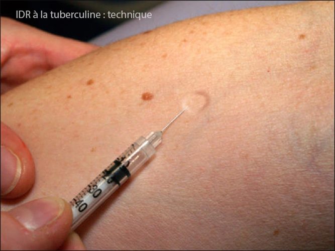 IDR tuberculine 1