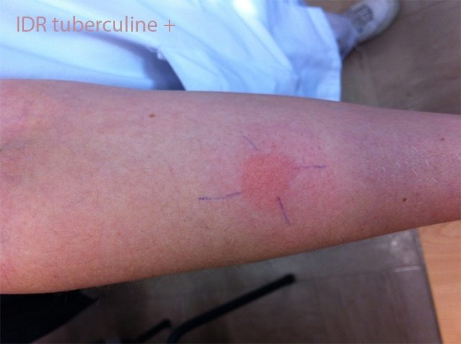 IDR tuberculine 3