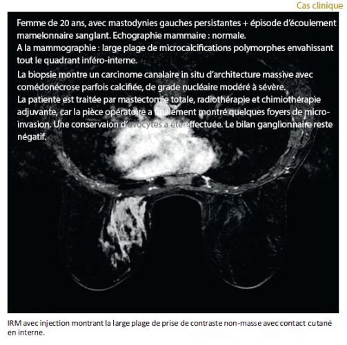 Microcalcifications