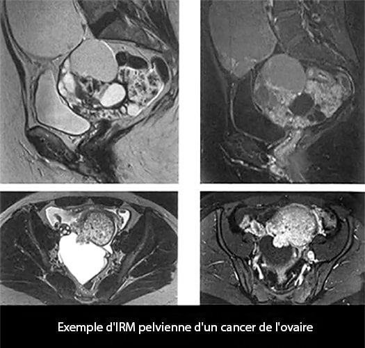 IRM_cancer ovaire