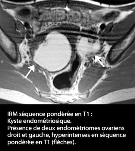 IRM endométriose — image IRM lésions endométriosiques pelviennes 1