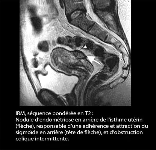 IRM endométriose — image IRM lésions endométriosiques pelviennes 10