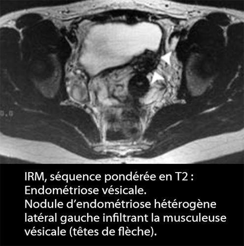 IRM endométriose — image IRM lésions endométriosiques pelviennes 11