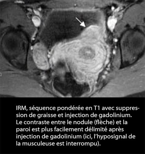 IRM endométriose — image IRM lésions endométriosiques pelviennes 12