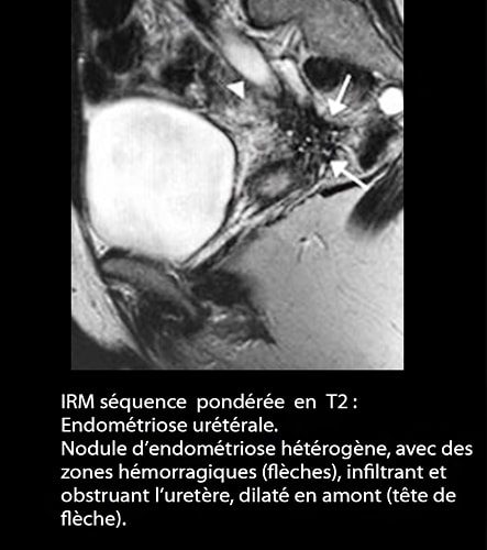 IRM endométriose — image IRM lésions endométriosiques pelviennes 13