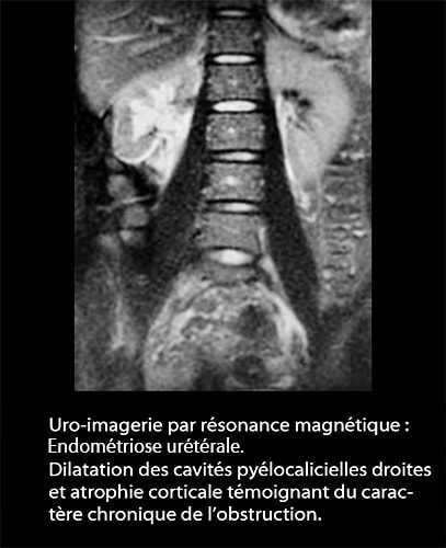 IRM endométriose — image IRM lésions endométriosiques pelviennes 14
