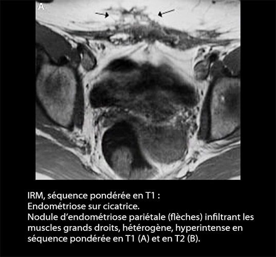 IRM endométriose — image IRM lésions endométriosiques pelviennes 15