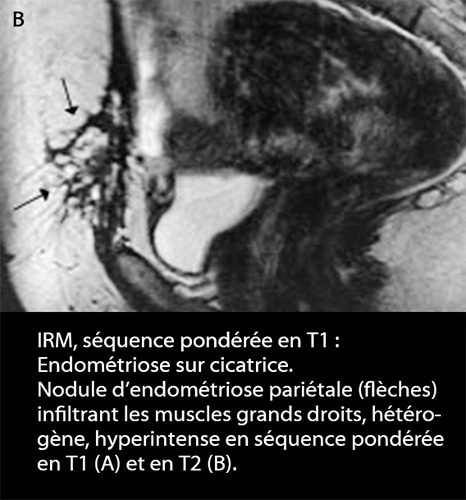 IRM endométriose — image IRM lésions endométriosiques pelviennes 16