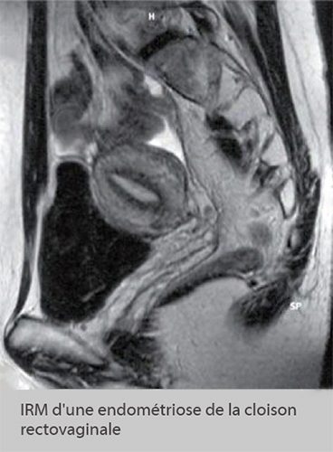 IRM endométriose — image IRM lésions endométriosiques pelviennes 17