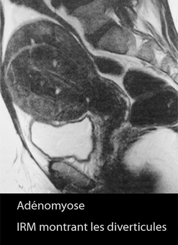 IRM endométriose — image IRM lésions endométriosiques pelviennes 18