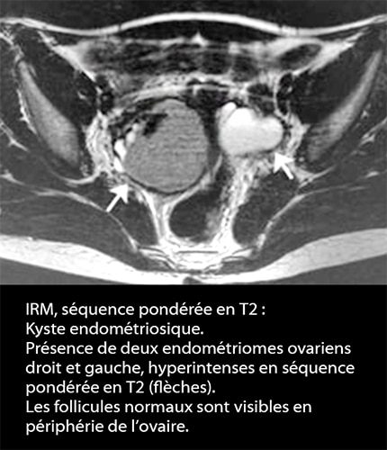 IRM endométriose — image IRM lésions endométriosiques pelviennes 2