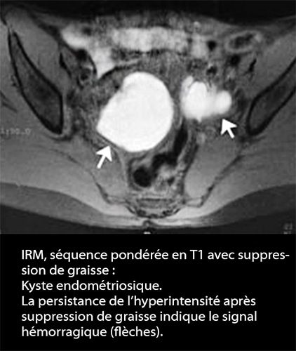 IRM endométriose — image IRM lésions endométriosiques pelviennes 3