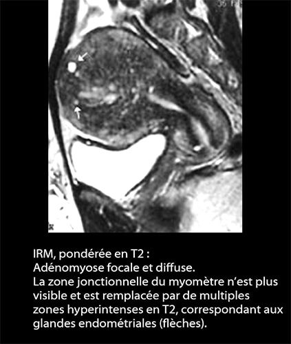 IRM endométriose — image IRM lésions endométriosiques pelviennes 4