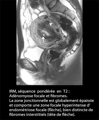 IRM endométriose — image IRM lésions endométriosiques pelviennes 5