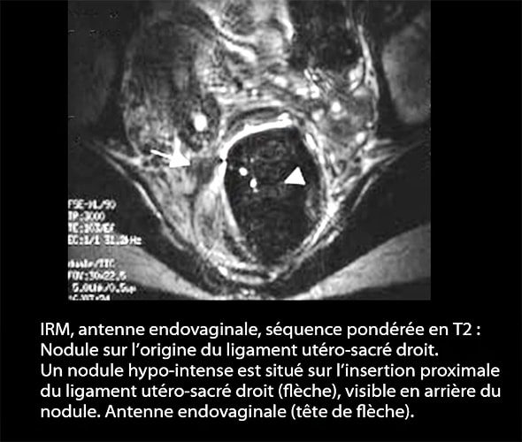 IRM endométriose — image IRM lésions endométriosiques pelviennes 6