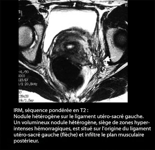 IRM endométriose — image IRM lésions endométriosiques pelviennes 7