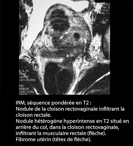 IRM endométriose — image IRM lésions endométriosiques pelviennes 8